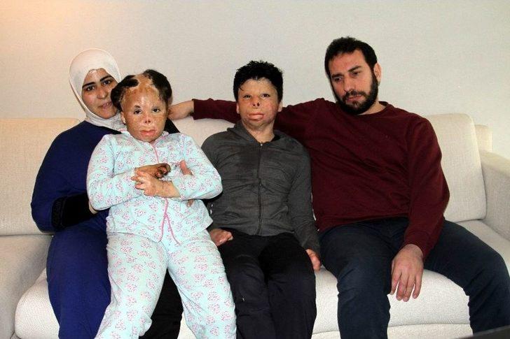 Halep’te Bombalı Saldırıda Elleri Ve Yüzleri Yanan Suriyeli Kardeşlerin Yardım Çığlığı G4