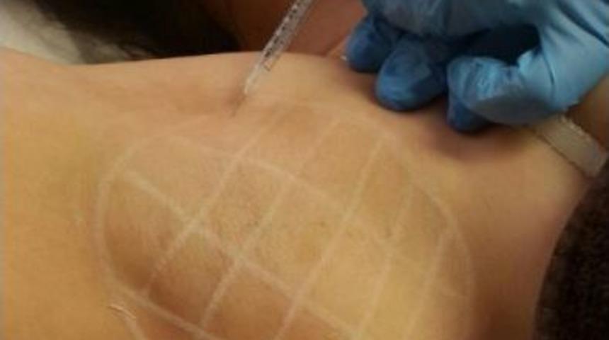 Koltuk Altı Terlemesine Botokslu &Ccedil;&ouml;z&uuml;m