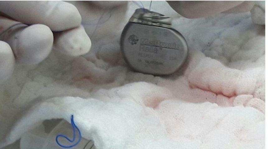 Karaman Devlet Hastanesinde İlk Kez Kalp Pili Takıldı