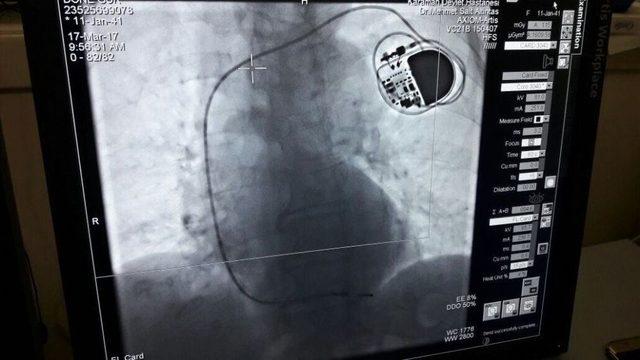 Karaman Devlet Hastanesinde İlk Kez Kalp Pili Takıldı