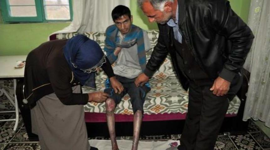 Epidermolisis B&uuml;lloza Hastası, Her G&uuml;n Biraz Daha Eriyor