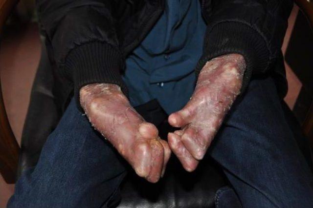 Epidermolisis Bülloza Hastası, Her Gün Biraz Daha Eriyor