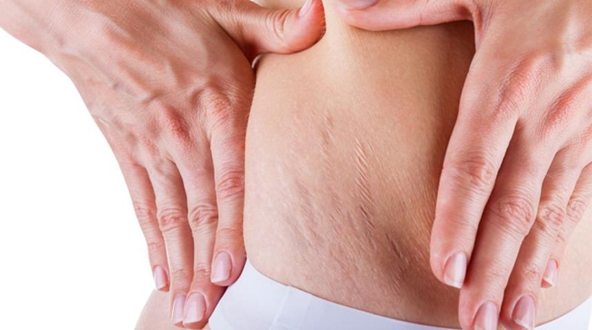 V&uuml;cudunuzdaki &ccedil;atlaklardan kurtulun!