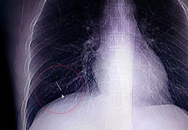 Göğüs Kafesinde 2 Santimetre Iğne Çıkartıldı