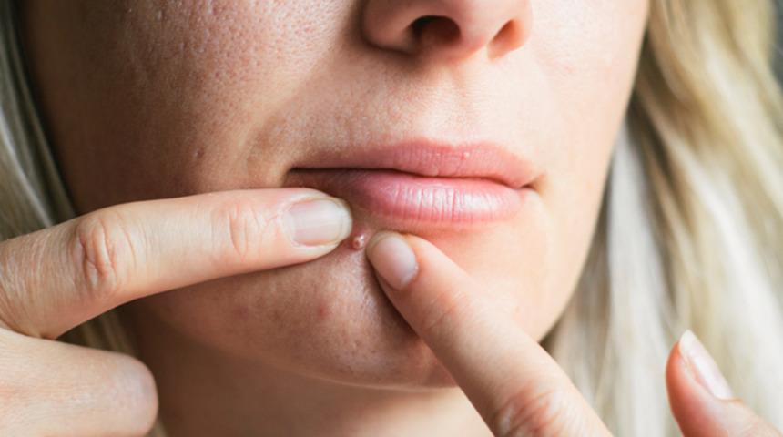 30 yaşına gelip hala sivilceyle mücadele edenlerin çok iyi anlayacağı 16 şey