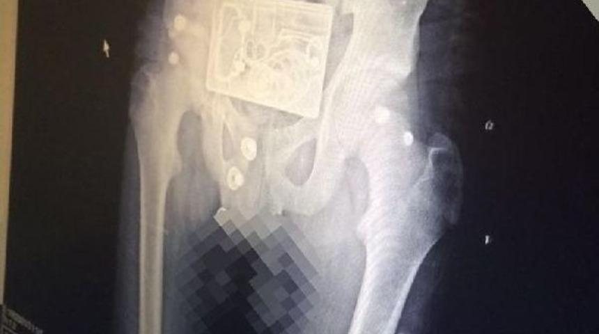 Kemer Tokasındaki Bomba Ve Tabanca Deseni R&ouml;ntgende &Ccedil;ıkınca Canlı Bomba Sanıldı