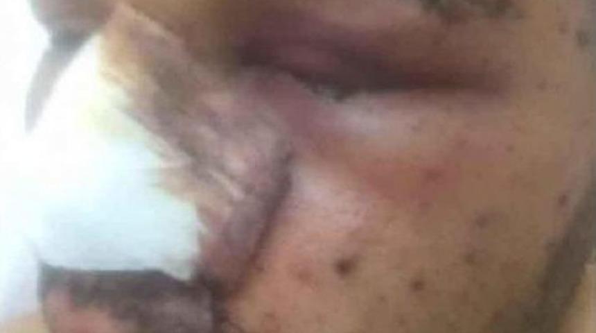 El Bab'da Yaralanan Uzman Onbaşı: Bir G&ouml;z&uuml; Kaybettiysek Diğeri Bize Yeter