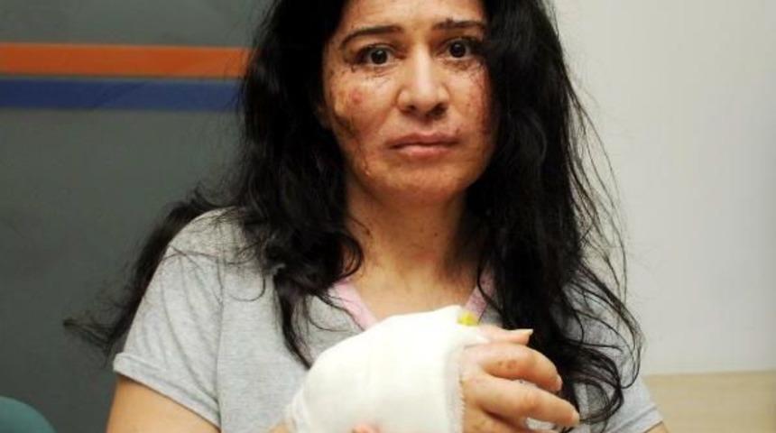 Deri Hastası Annenin Feryadı: Kızım I&ccedil;in Yaşamak Istiyorum