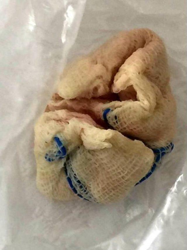 Bademcik Ameliyatı Olan Kızın Boğazında Gazlı Bez Unutuldu 2