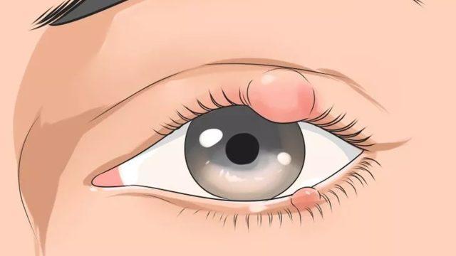 Arpacığa ne iyi gelir, nasıl geçer? Evde arpacık tedavisi için doğal yöntemler nelerdir, arpacık neden olur?