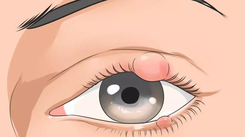 Arpacığa ne iyi gelir, nasıl geçer? Evde arpacık tedavisi için doğal yöntemler nelerdir, arpacık neden olur?