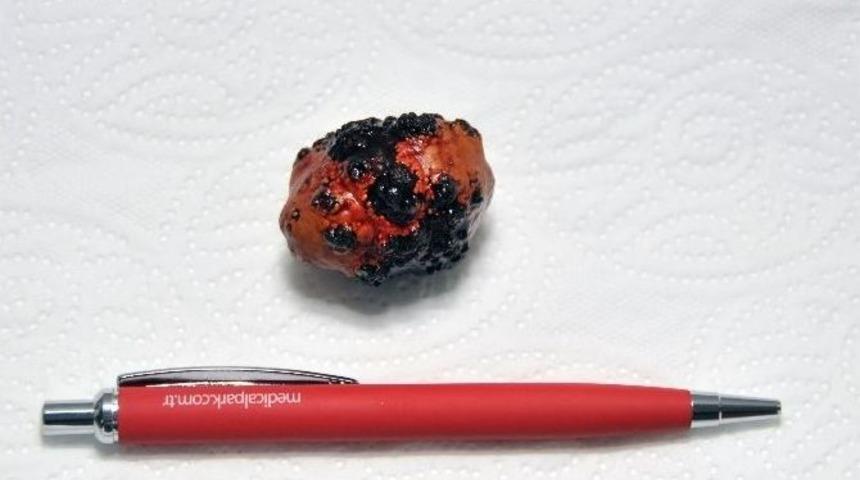 Mesanesinden 4 Cm&rsquo;lik Taş &Ccedil;ıktı