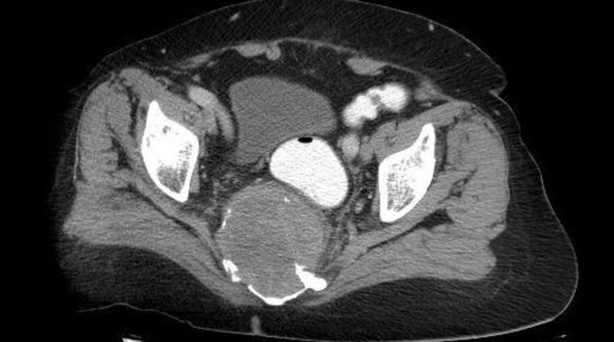 Bel Fıtığı Şikayetiyle Gittiği Hastanede Oturak Kemiğinde 10 Santimetrelik T&uuml;m&ouml;r &Ccedil;ıktı