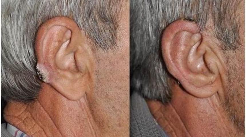 Salihli Devlet Hastanesi, Cilt Kanseri Hastalarına Umut Oldu