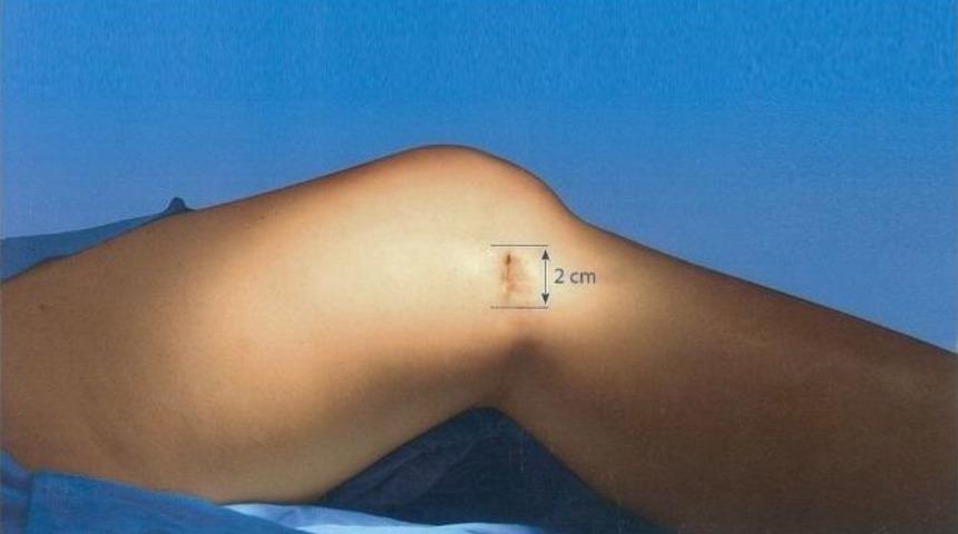 Ncr&rsquo;de By-pass Damarı &Ccedil;ıkarılırken Bacakta Kesi İzi Kalmıyor