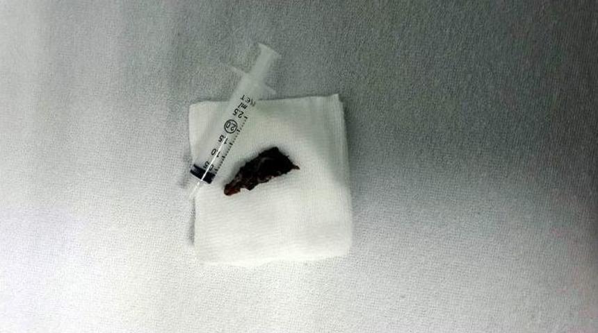 Soluk Borusundan 2,5 Santimlik Yabancı Cisim &Ccedil;ıkartıldı