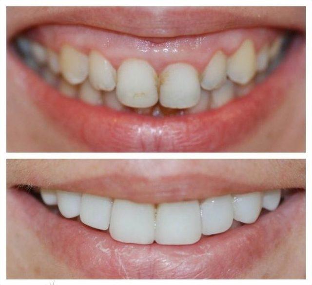 (özel Haber) 14 Şubat Öncesi Çiftlerde Diş Bakımı Telaşı 1