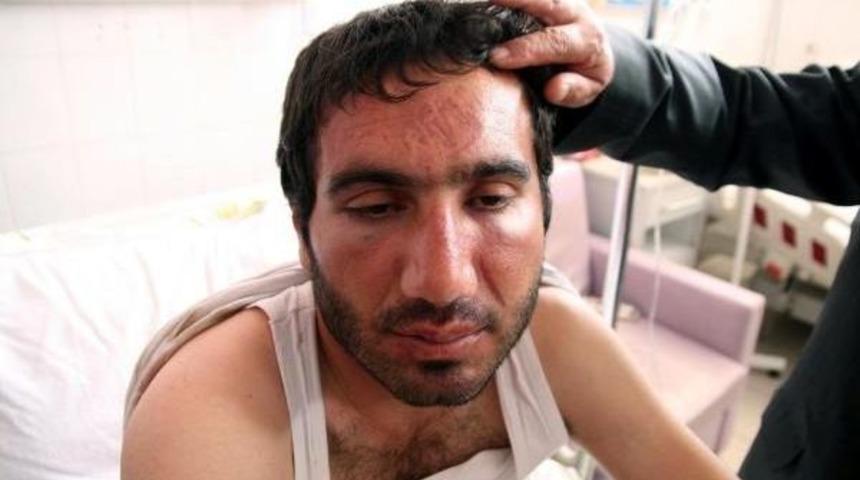 Alında Bot Izi &Ccedil;ıkartan Polis Dayağına Yargıtay Ayarı: İşkence Olabilir