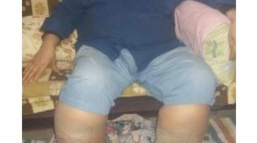 Fil Hastalığına Yakalanan 6 &Ccedil;ocuk Babası Yardım Bekliyor