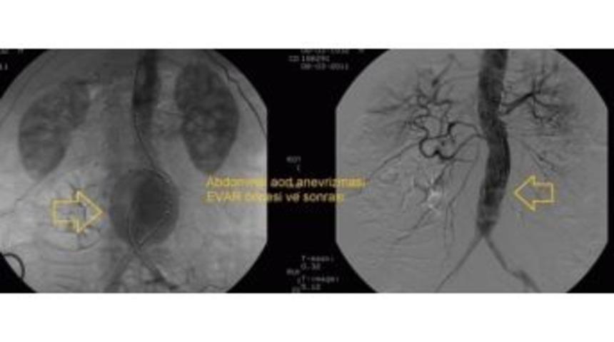 Aort Damarındaki Genişleme İ&ccedil;in "evar" Tedavisi