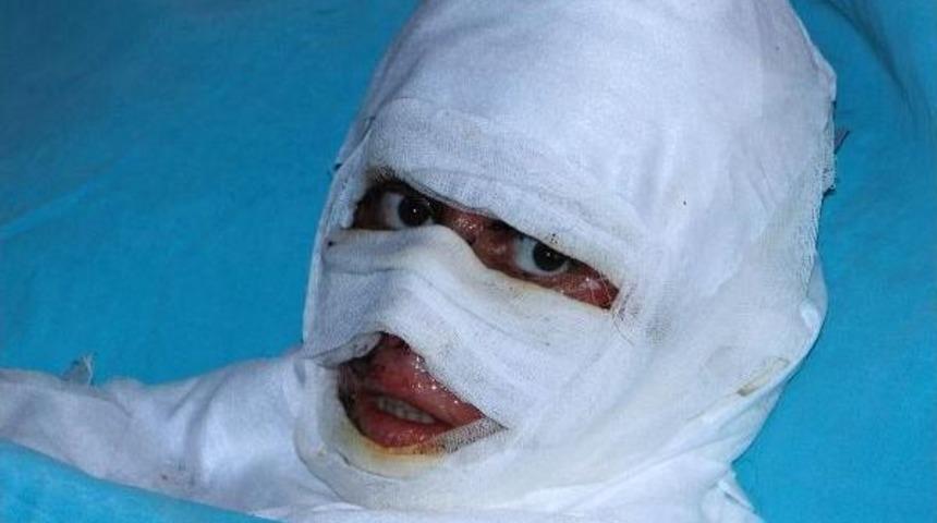 Suriye'de V&uuml;cudu Yanan Aişe, Sivas'ta Tedavi G&ouml;r&uuml;yor