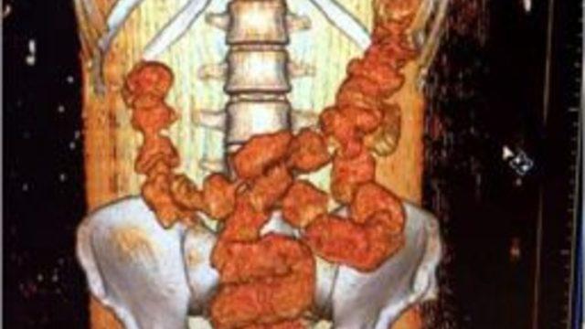 Midesinden 18 Prezervatif Içinde Sıvı Kokain Ele Geçirildi