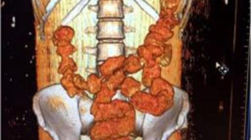 Midesinden 18 Prezervatif I&ccedil;inde Sıvı Kokain Ele Ge&ccedil;irildi