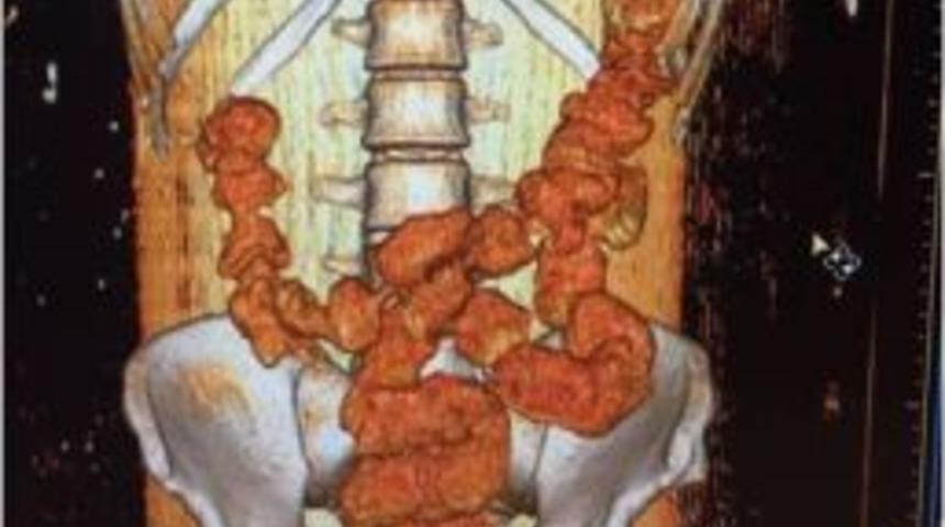 Sindirim Siteminden Uyuşturucu &Ccedil;ıktı