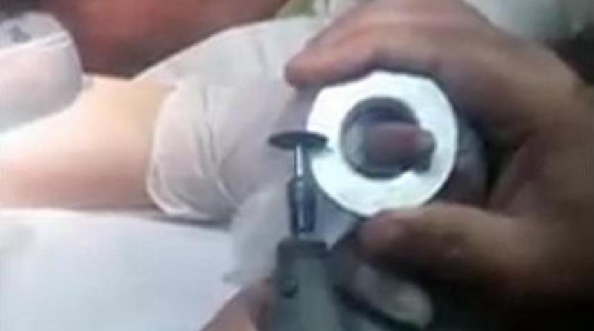 Suriyeli Bebeğin K&uuml;ll&uuml;ğe Sıkışan Parmağı K&uuml;ll&uuml;k Kesilerek &Ccedil;ıkarıldı