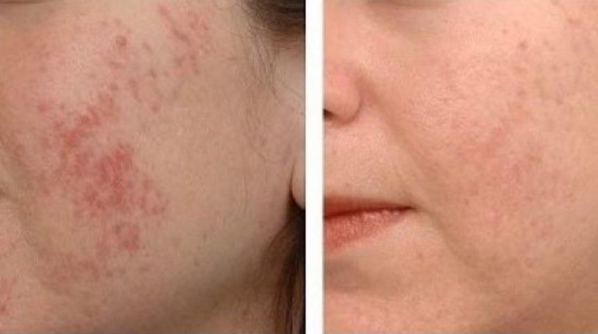 &lsquo;altın İğne&rsquo; G&uuml;zelliği