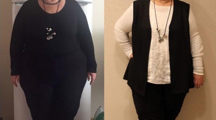 T&uuml;p Mide Ameliyatıyla Artık Daha Sağlıklı