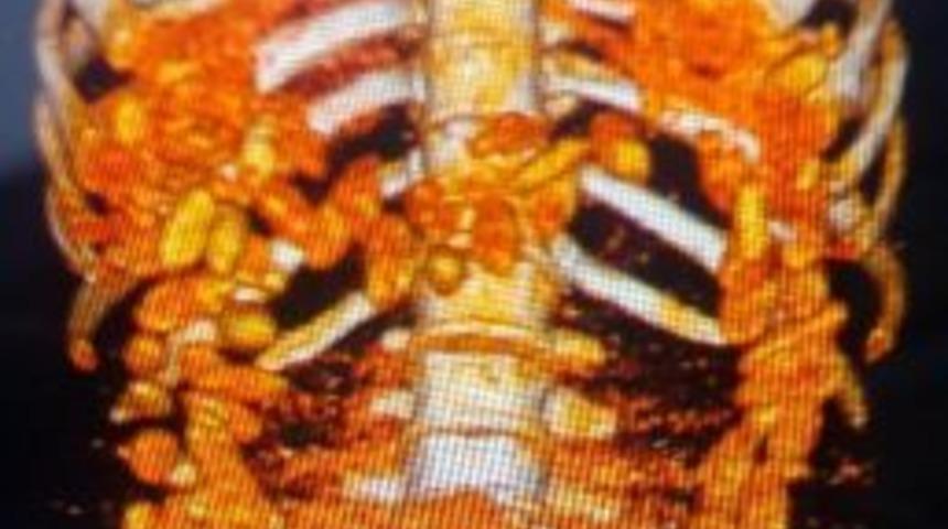 (&ouml;zel Haber) Uyuşturucu Ka&ccedil;ak&ccedil;ısının Sindirim Sisteminde 1 Kilo 300 Gram Kokain &Ccedil;ıktı