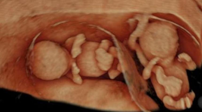 Ultrasonda çığır açtılar; 4 boyutlu mucize