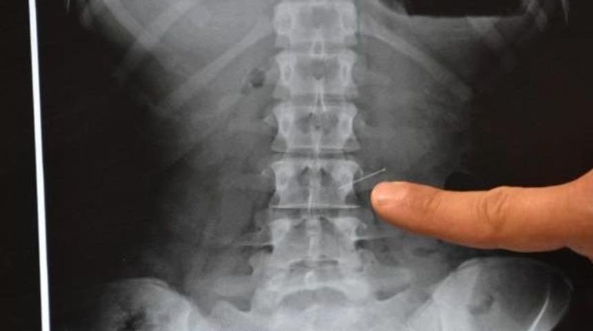 Eşarbını Tutturmak I&ccedil;in Ağzına Aldığı Toplu Iğneyi Yuttu