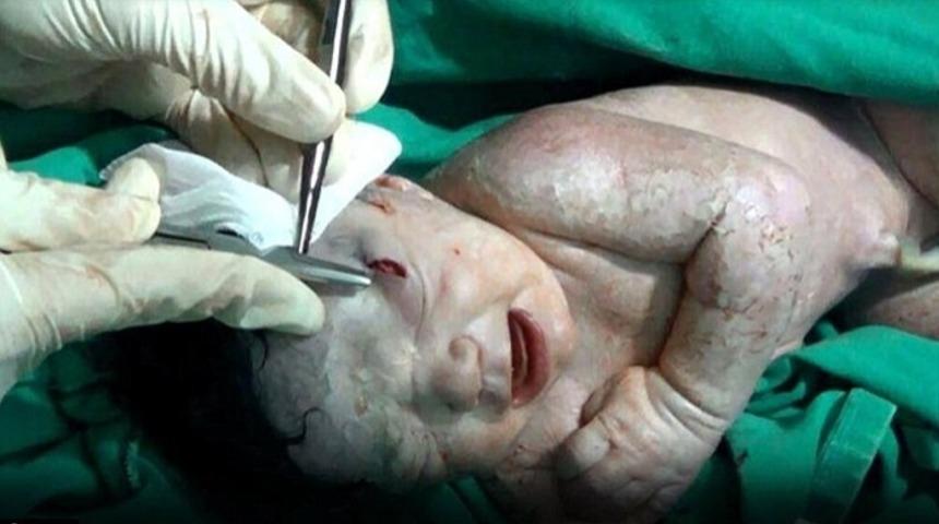 Anne karnında vurulan bebek, kafasında şarapnelle doğdu!