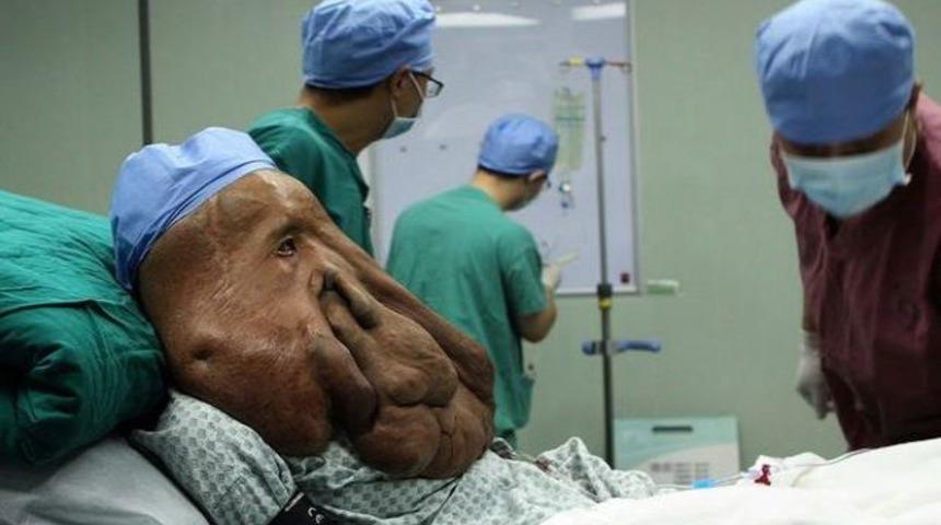 En büyük yüz tümörü operasyonu