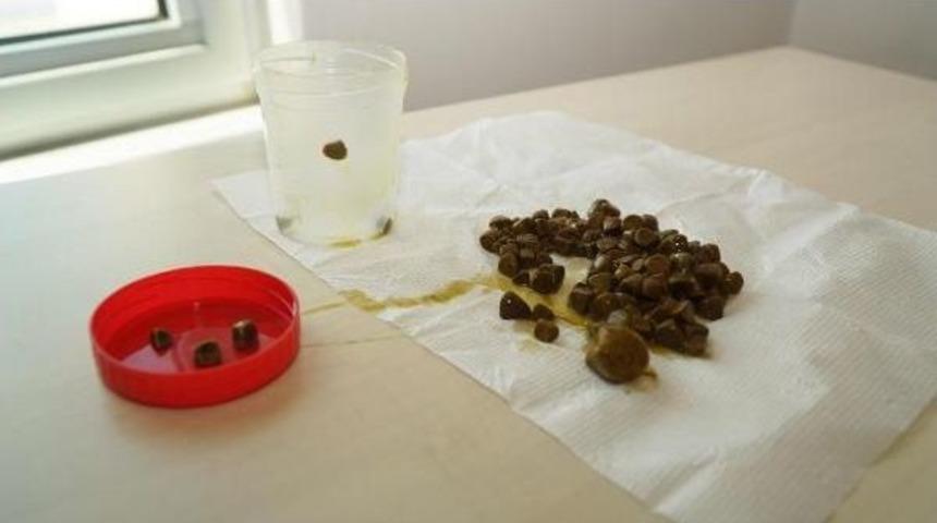 Safra Kesesinden 100 Taş &Ccedil;ıkartıldı