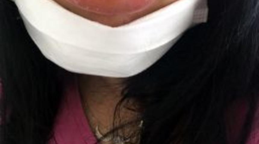 Dudak Faciası Mağdurları Artıyor