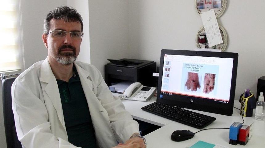 Bu Hastalığın D&uuml;nyada Tam Tedavisi Yok: &rsquo;kelebek Hastalığı&rsquo;