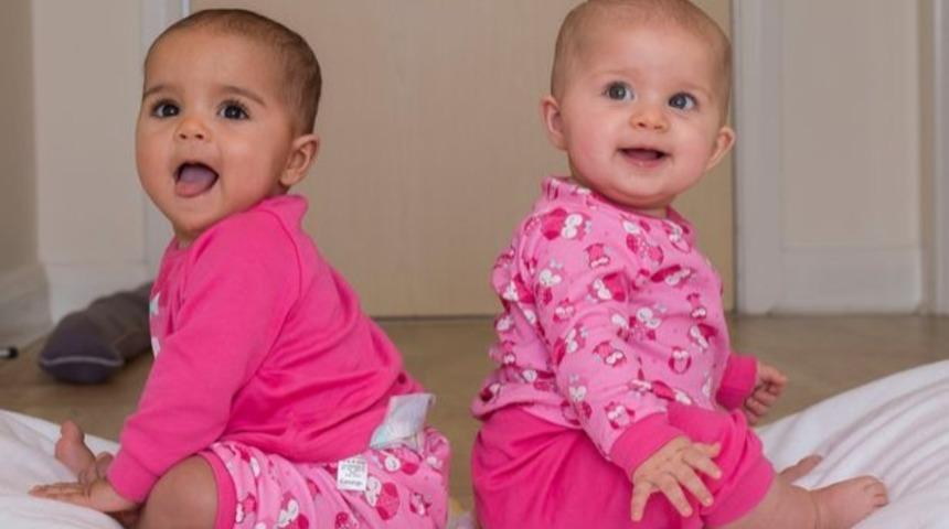 Farklı renkte cilde sahip ikizlerle tanışın!