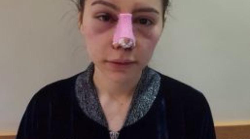 &Ccedil;aldığı Paralarla Burnuna Estetik Yaptırdı