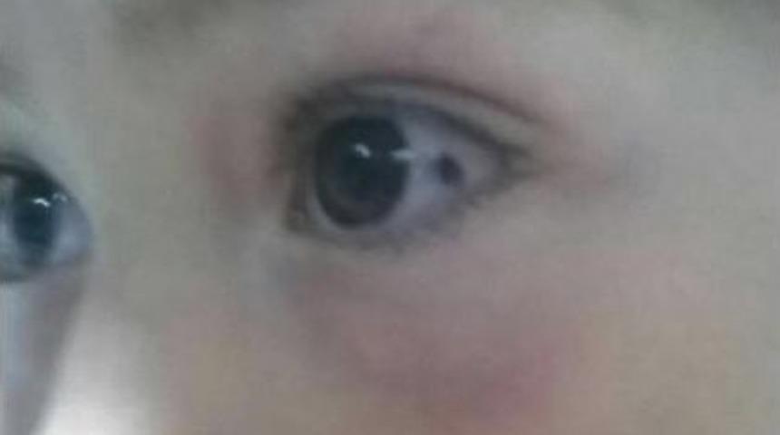 K&uuml;&ccedil;&uuml;k Kızın G&ouml;z&uuml;ne Yapışan Kene Ameliyatla Alındı