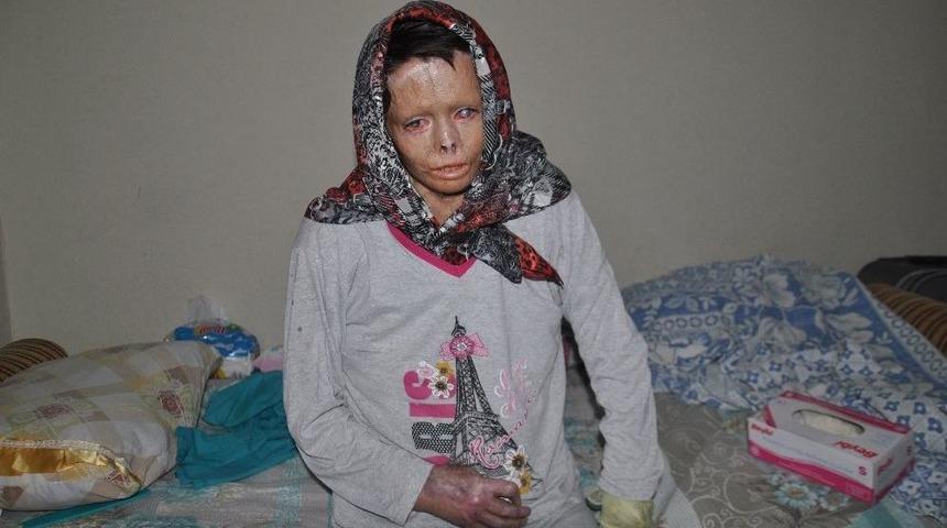 Esad&rsquo;ın Yaktığı Suriyeli Nuha T&uuml;rkiye&rsquo;de Şifa Buluyor