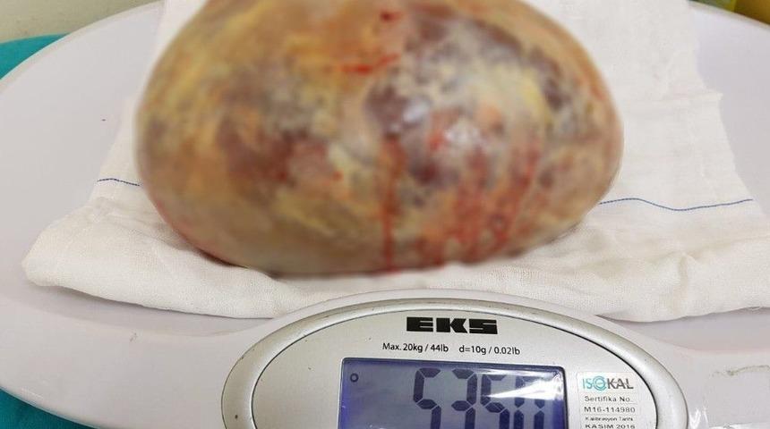 Samsun&rsquo;da Bir Hastadan 5 Kilo 350 Gram Kist &Ccedil;ıkarıldı