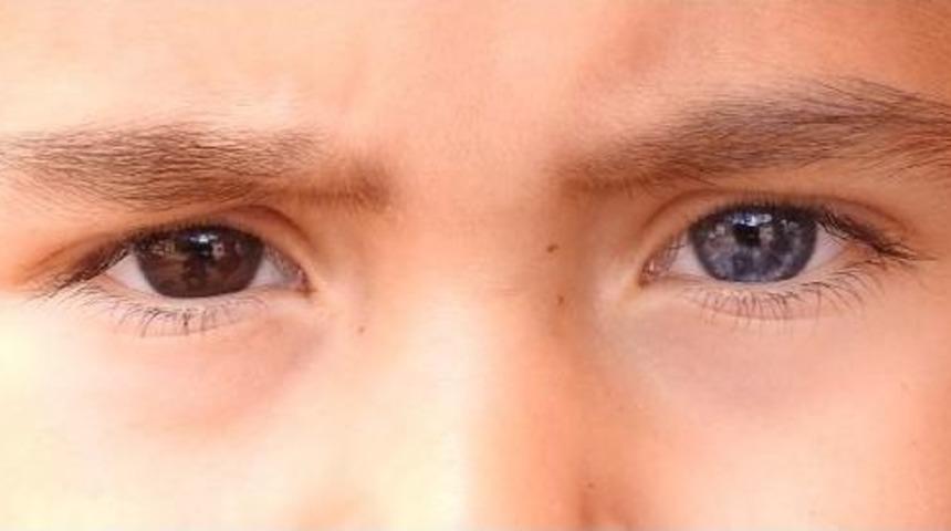 K&uuml;&ccedil;&uuml;k H&uuml;seyin'in Bir G&ouml;z&uuml; Mavi Diğeri Kahverengi