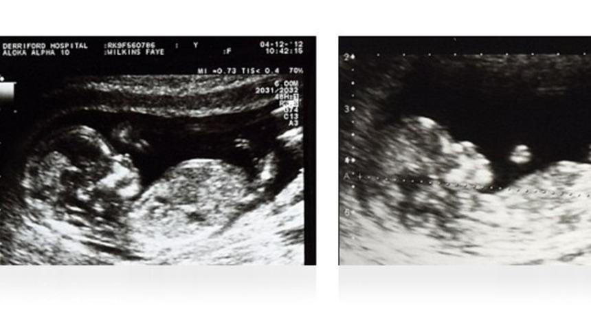 Mucizelere inanır mısınız?  Ayrı rahimlerde 2 mucize