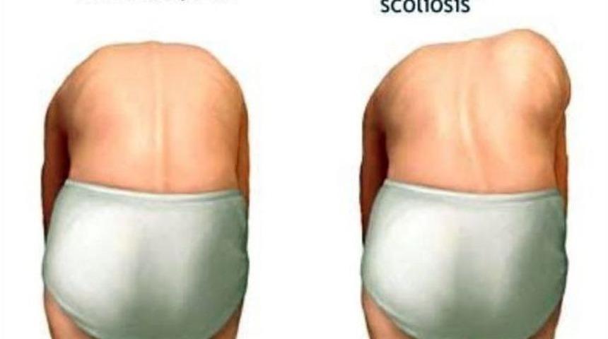 Öğretmenlere Ve Ailelere Skolyoz Uyarısı