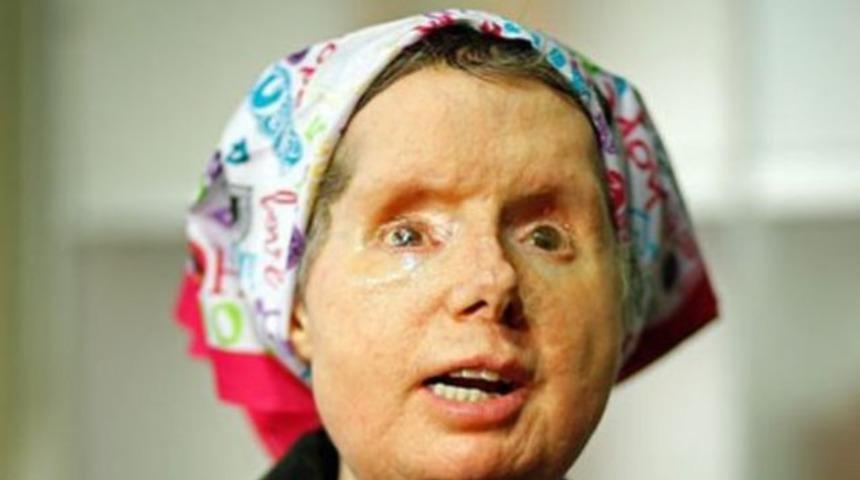 Y&uuml;z&uuml;n&uuml; şempanze par&ccedil;alayan kadına y&uuml;z nakli