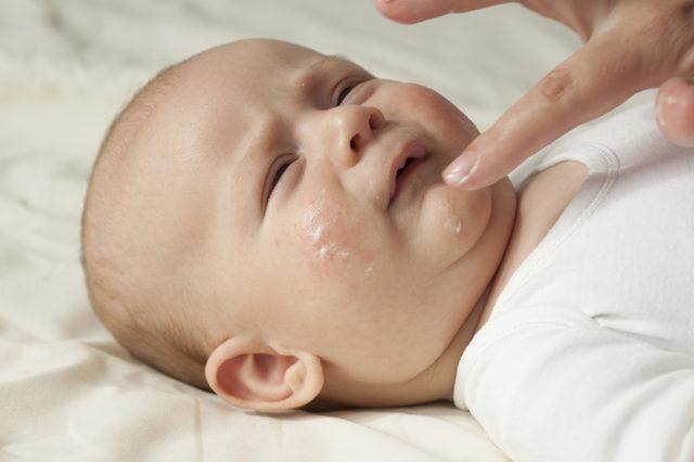 anne sütü alan bebeklerde alerji