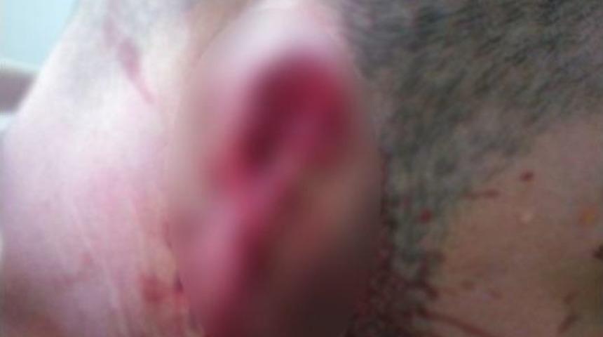 50 Tl İ&ccedil;in Arkadaşının Kulağını Isırarak Kopardığı İddiası